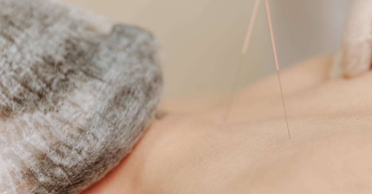 How Dry Needling Can Alleviate Chronic Muscle Pain