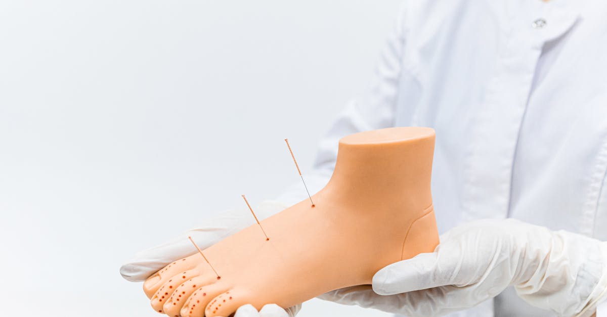 Using Acupuncture to Treat Fibromyalgia Symptoms